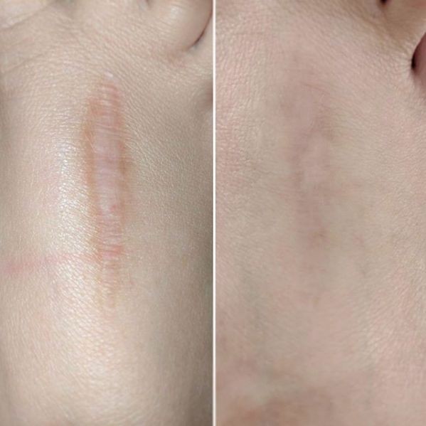 Scar Camouflage (session)