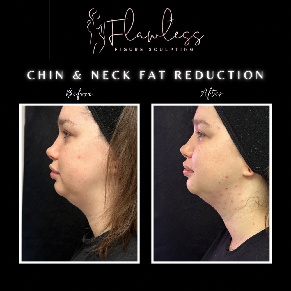 Chin & Neck Fat Reduction