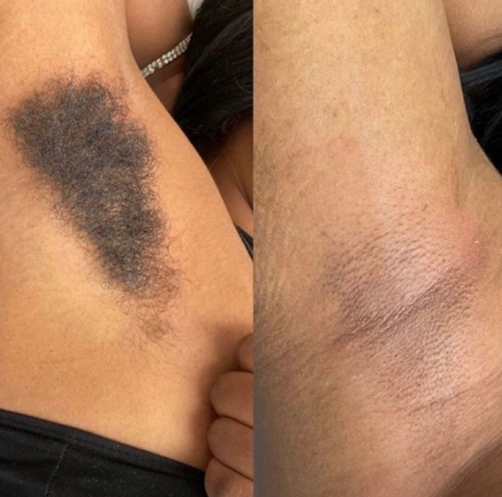 Underarm at LaSucre Esthetics in Nottingham, MD