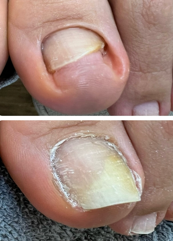 ONYCHOLYSIS (1  Nail Treatment)