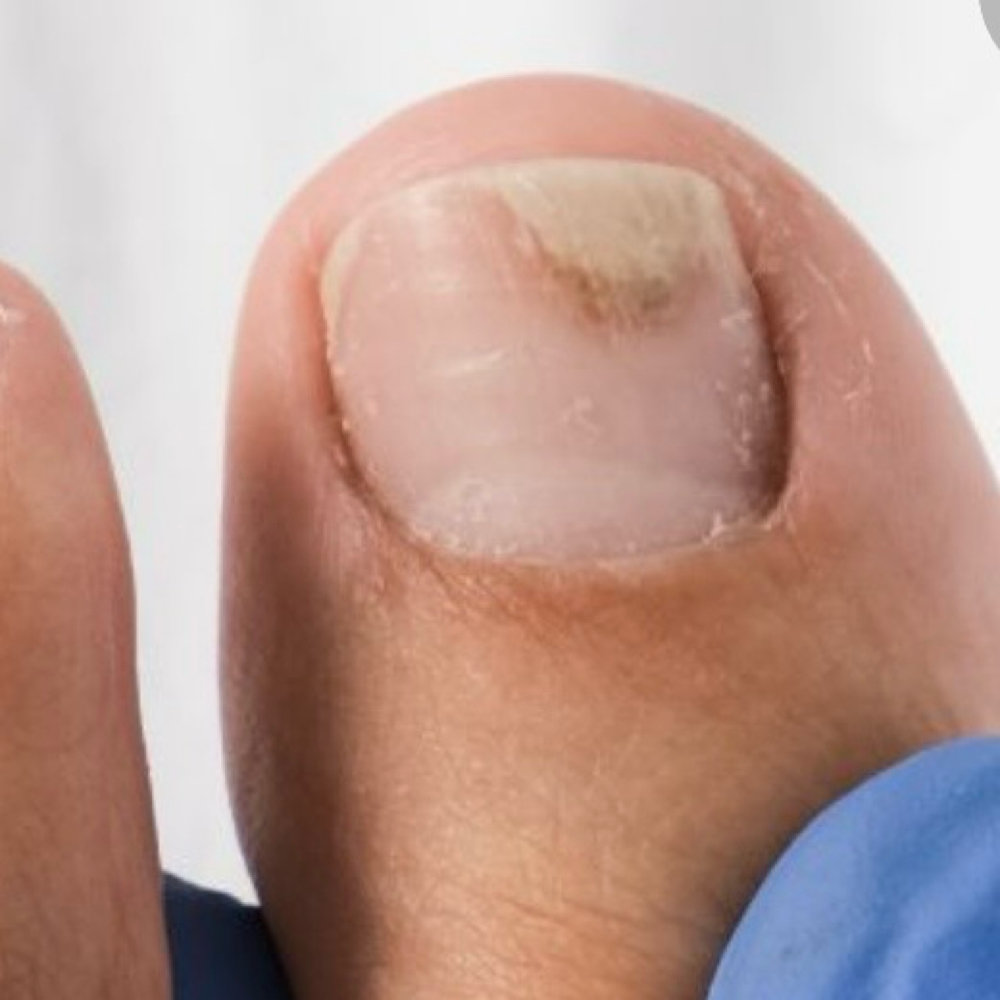 ONYCHOLYSIS (1  Nail Treatment) at Teas Podocenter in Ardmore, PA