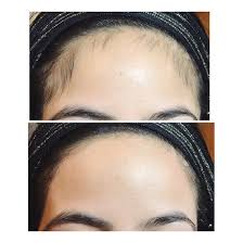 Hairline
