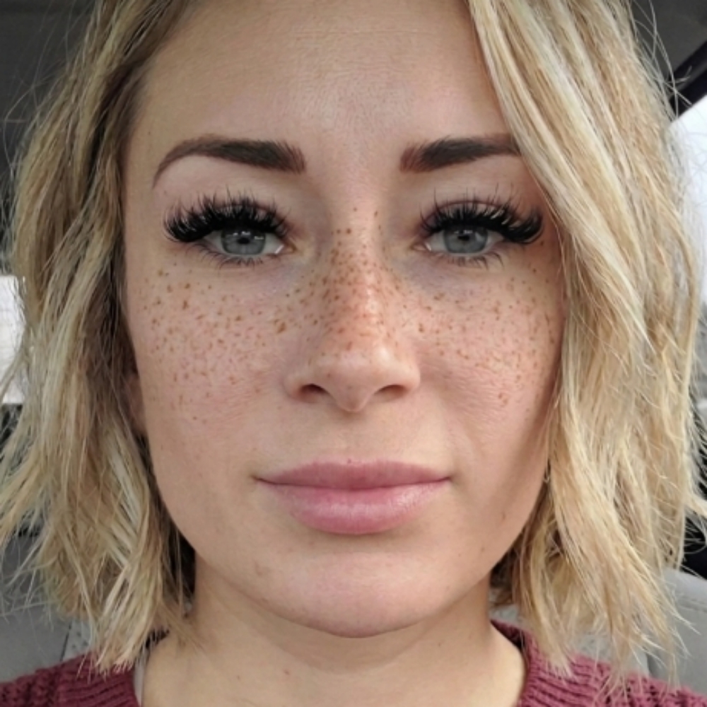 Freckles at Castle Aesthetics in Foley, AL