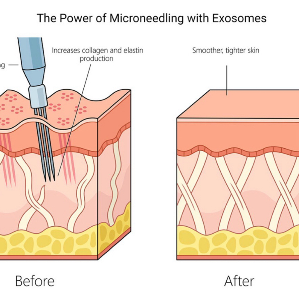 GHK-CU Microneedling Package at LV Aesthetics LLC in Wellington, FL