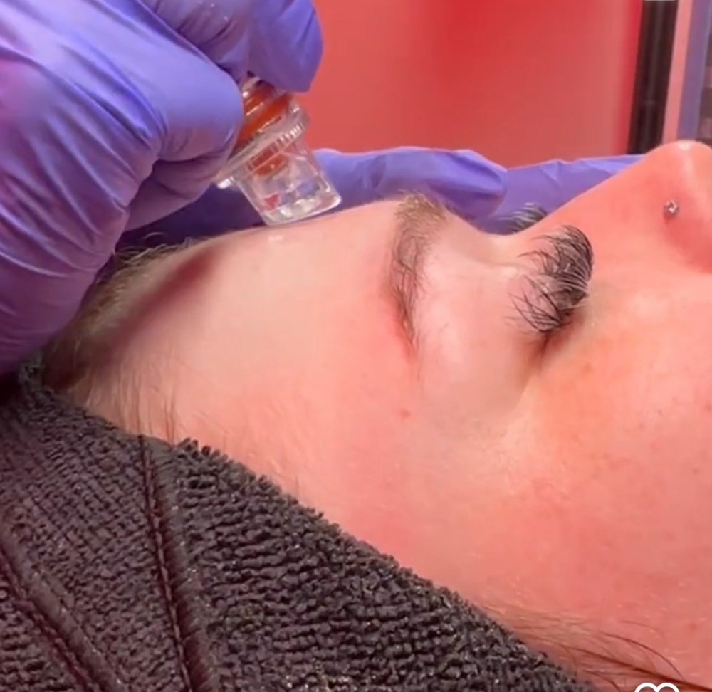 Hydrodermabrasion Facial