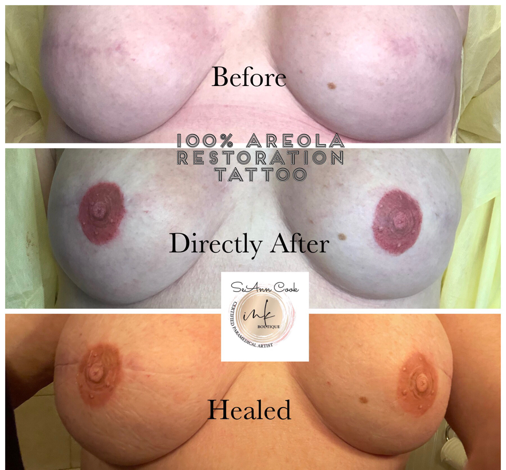 3D Areola Bilateral (both Breasts) at Beauty Edit in Fairview, OR