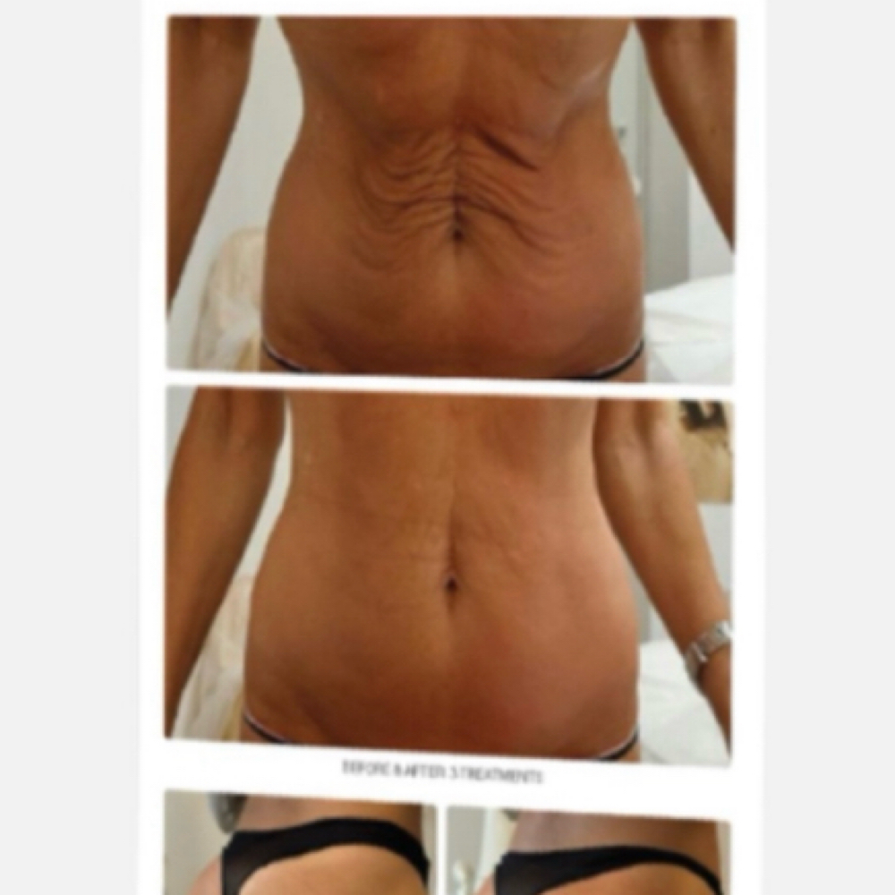 T-Shape 2 Body One Area (6 Visits) at Legacy MedSpa in Massapequa, NY