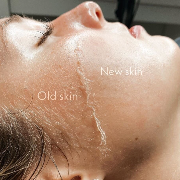 Dermaplane Express at Serenity Skin Studio in Wichita, KS