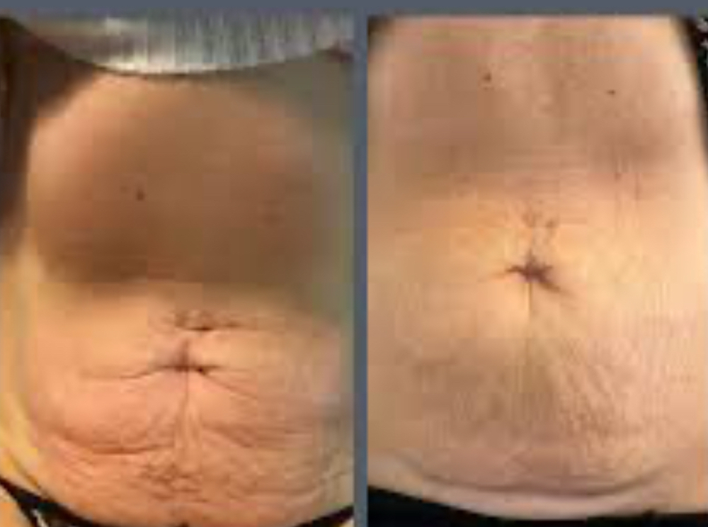 Radio Frequency Skin Tightening