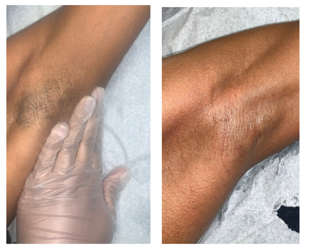 Underarms Wax