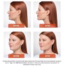 Kybella Injections-Face