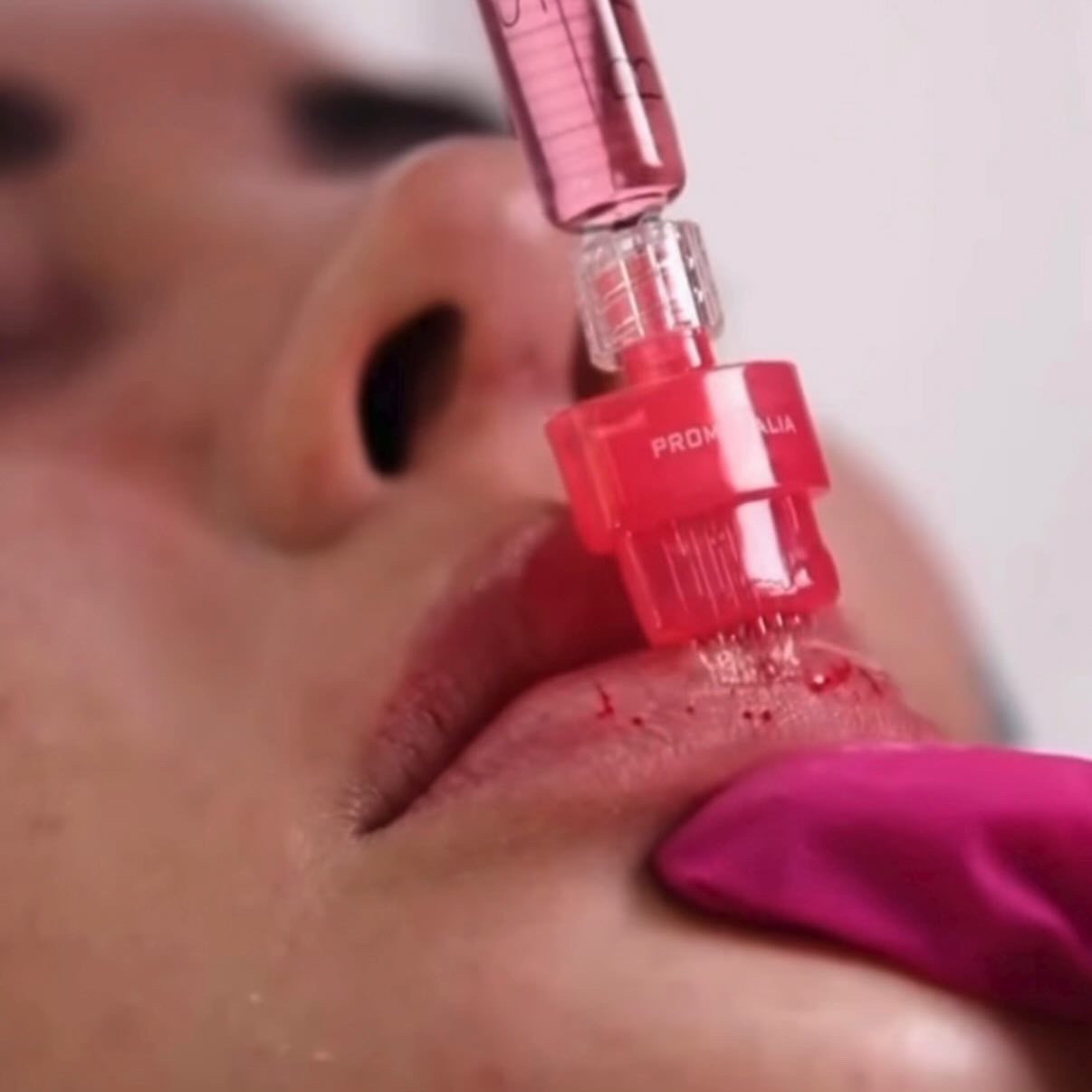 Tint Lip filler Rosie Lips at Gold Stone Beauty in mcallen, TX