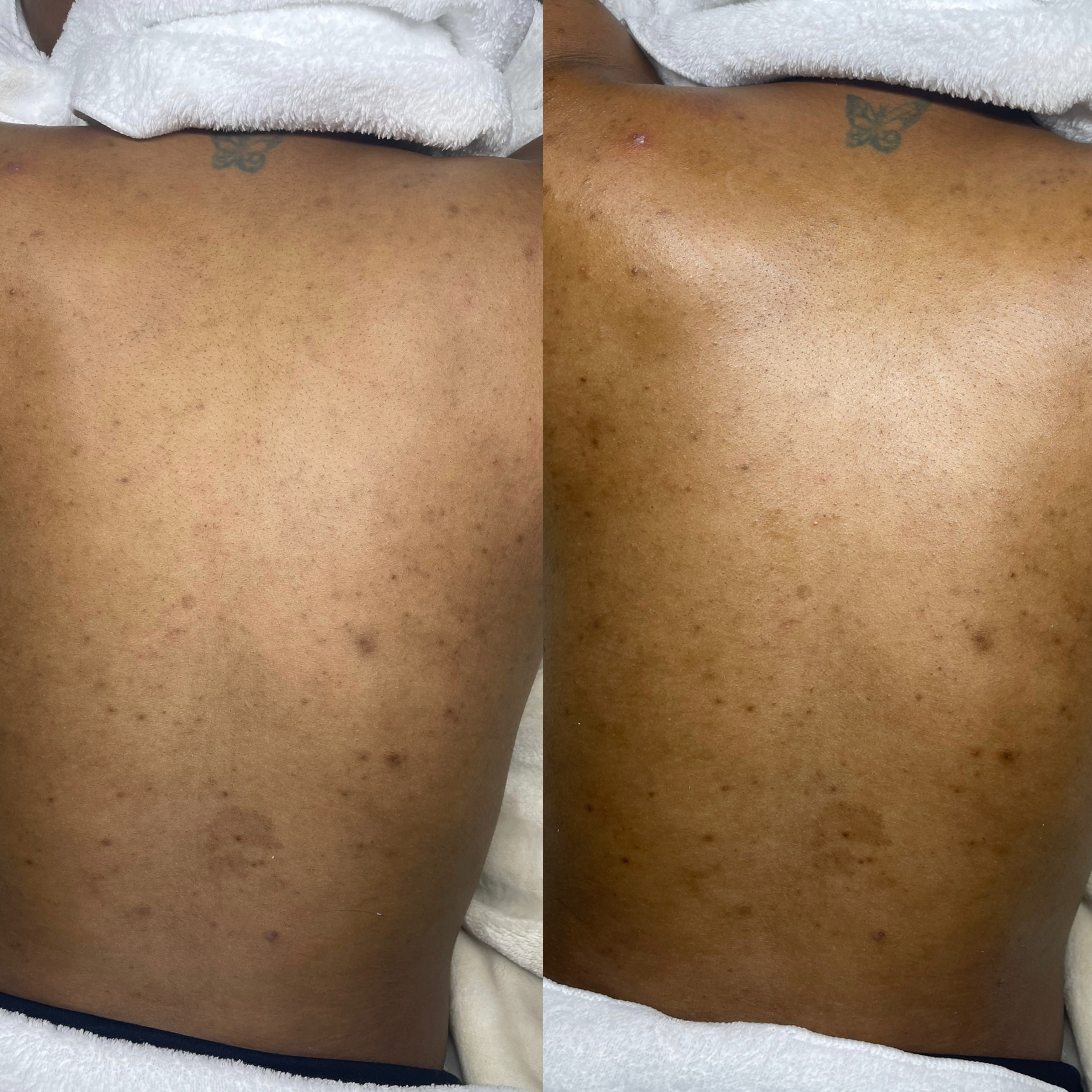 Radiance Back Treatment at Lexipureskin Aesthetics in Atlanta, GA