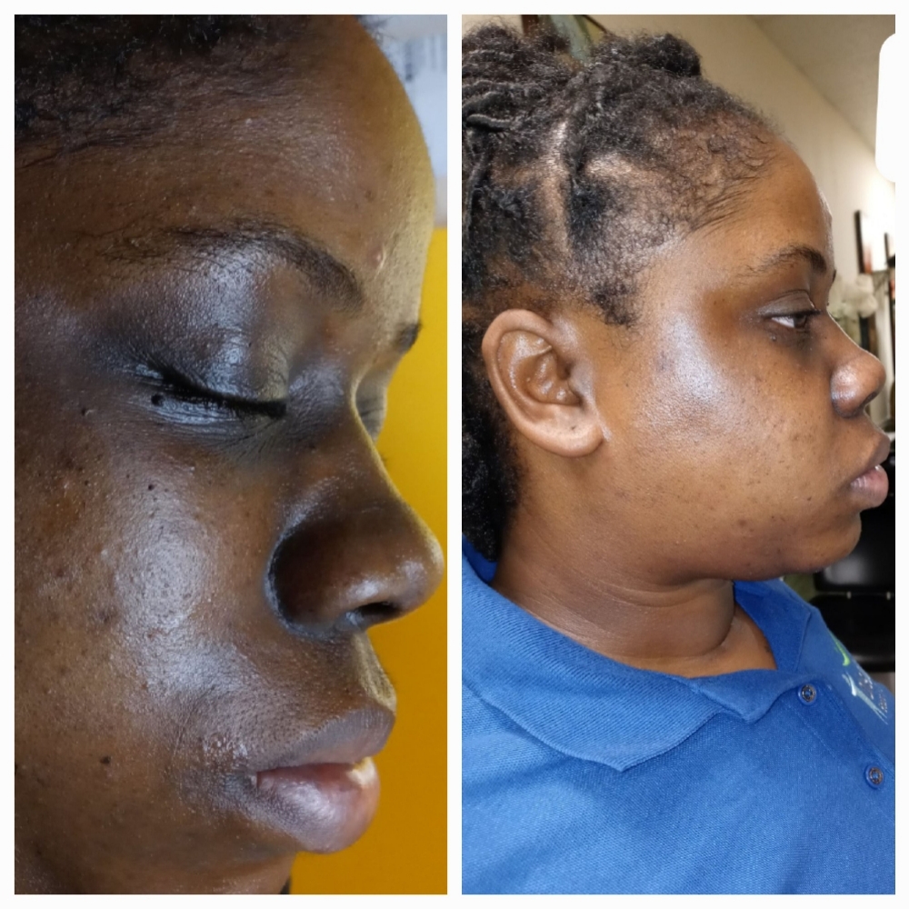 ✨ Sensi Peel Chemical at JUST BEAUTIFUL SKIN in Goose Creek, SC