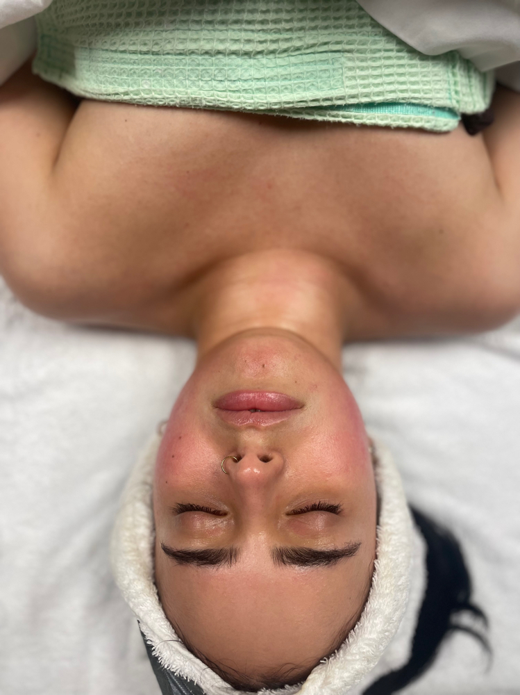 Chemical Peel Treatment Facial