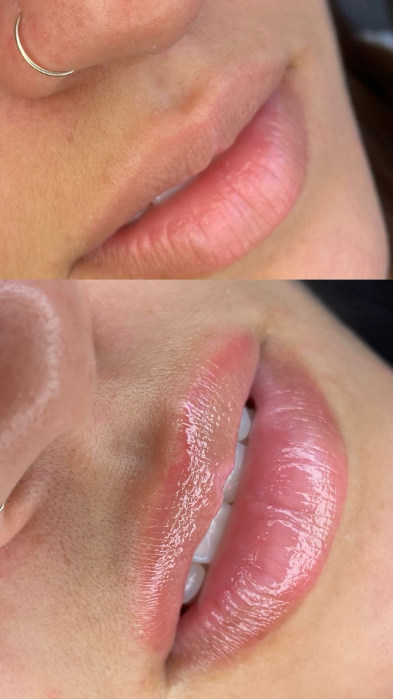 Hidra Gloss Treatment at Jessica Luchesi Skin Wellness in Elizabeth, NJ