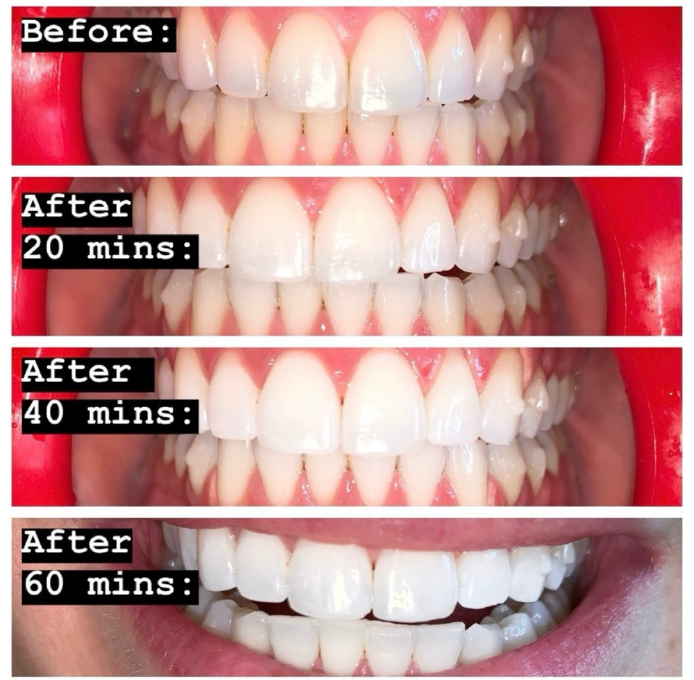 60 Min Teeth Brightening