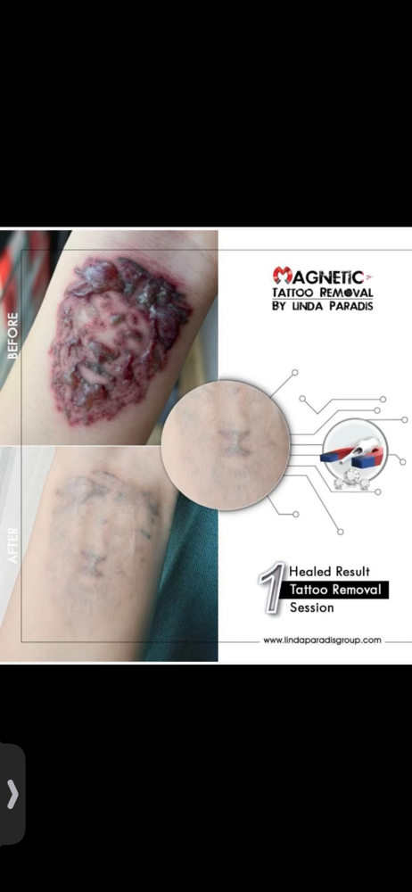 Tattoo Removal
