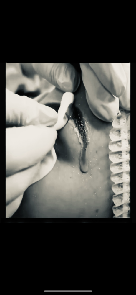 Tattoo Removal at Beauty by YaMeL in Santa Ana, CA