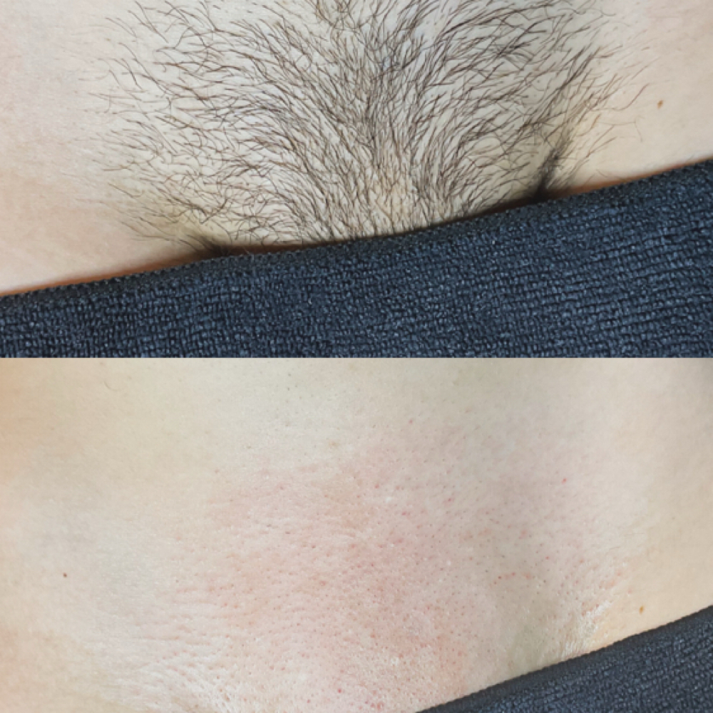 Brazilian at Glogetteresthetics in Warwick, RI