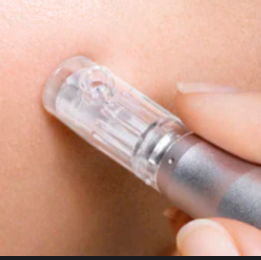Add Microneedling To Neck & Chest