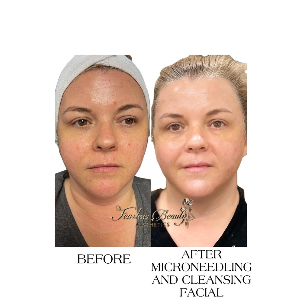 3 Microneedling Package