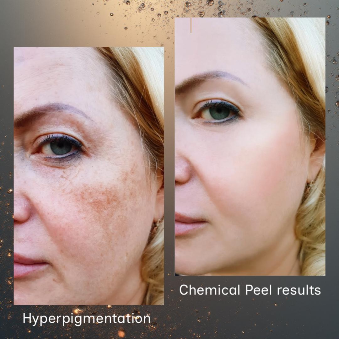 Medical Grade Chemical Peel at Glam & Glow MedSpa in Plano, TX