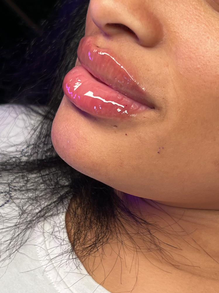 2ML FILLER (2 SESSIONS OF 1ML)