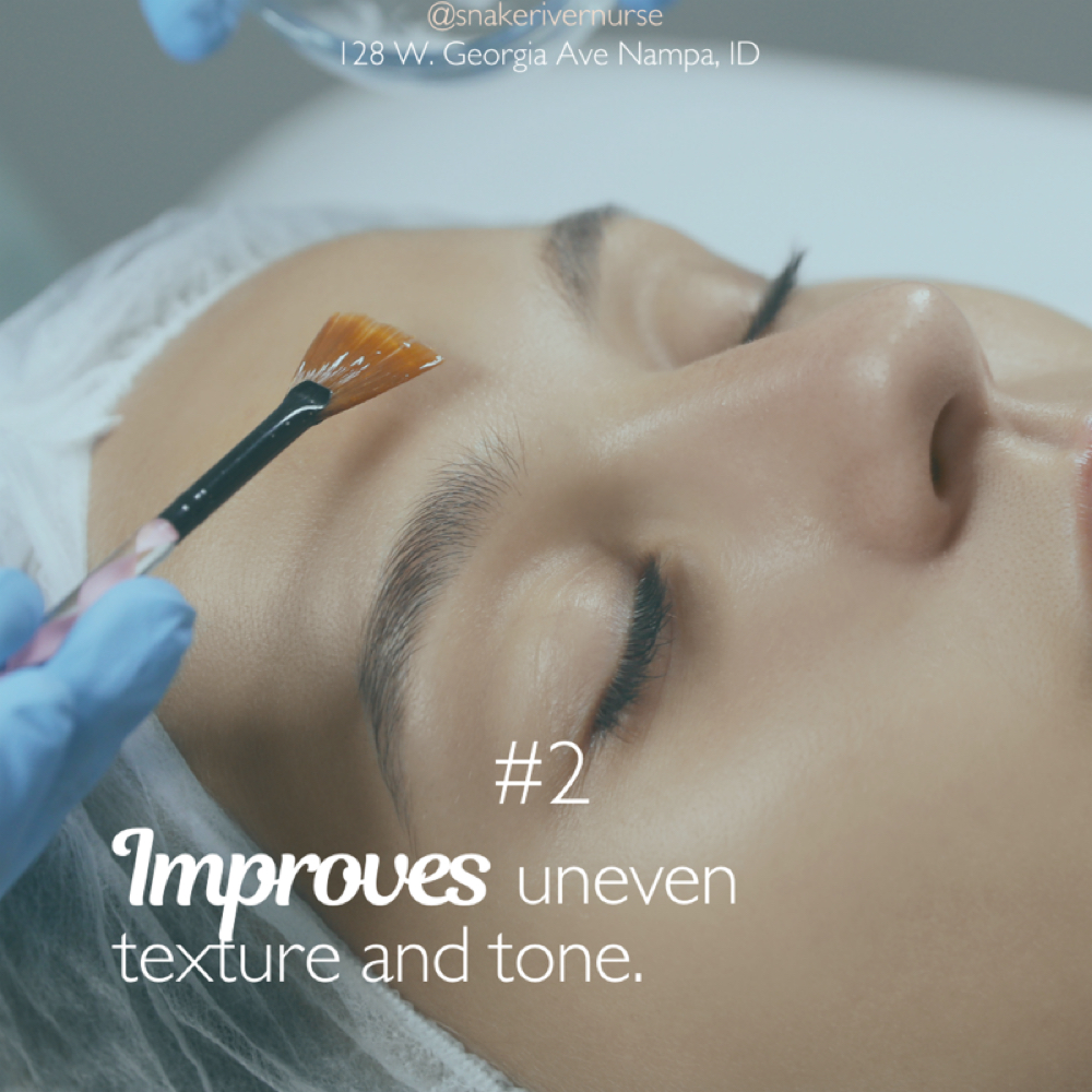Acne Chemical Peel at EVLO Salon Suites in Nampa, ID
