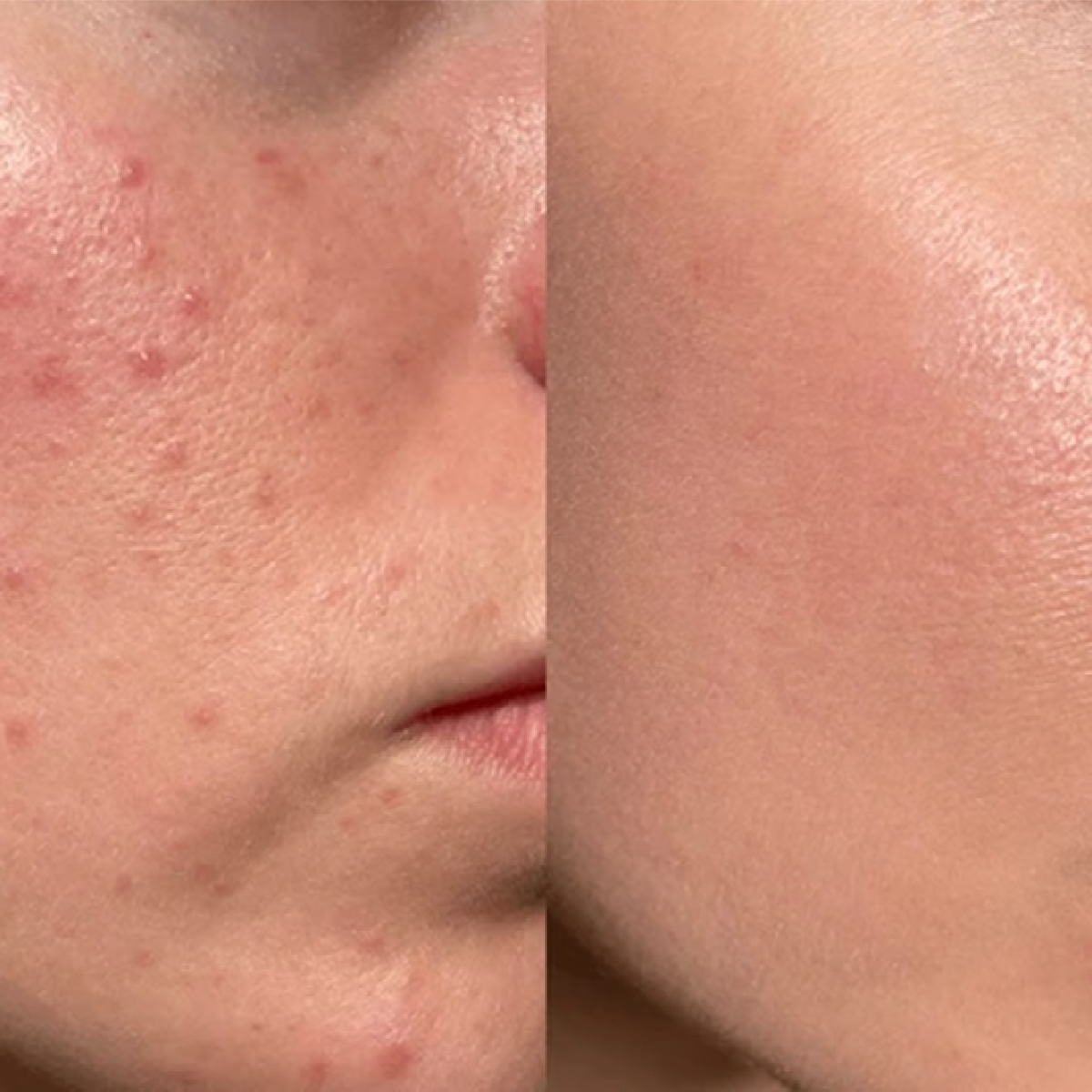 Acne Clearing Facial