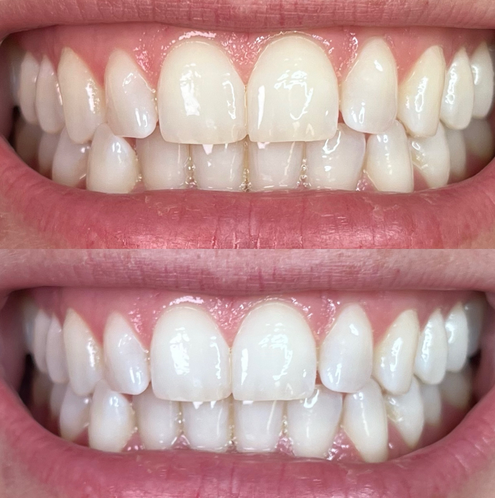 Sensitive Whitening at Bright White Co. in Crosslake, MN