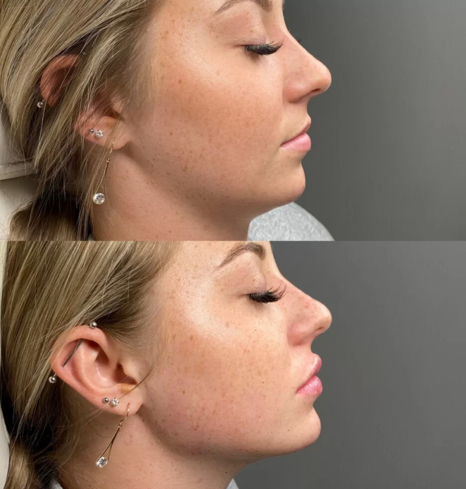 Chin Filler Special