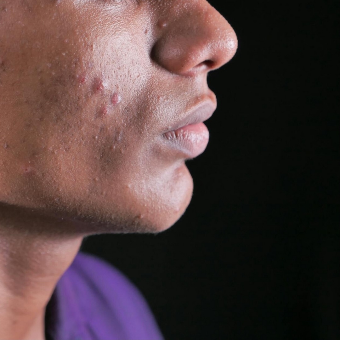 Acne Facial at FaceMe Skin Care in Bloomingdale, IL