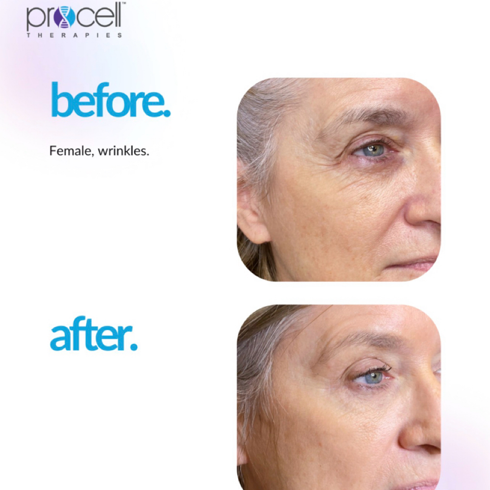 Face Procell Microchanneling at Blessed Beauty Aesthetics, LLC in Houston, TX