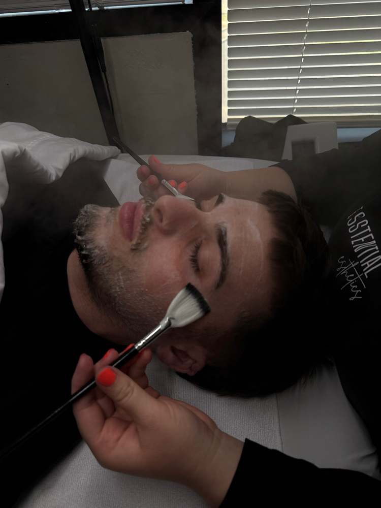 Chemical Peel