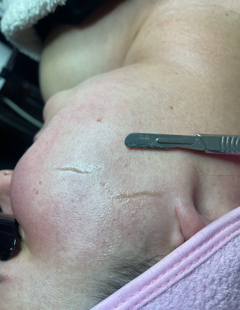 Dermaplaning Facial
