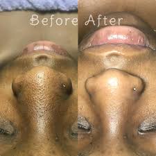 Extra Extractions (10+ minutes) at Unspoken Beauty Aesthetics in Port Saint Lucie, FL