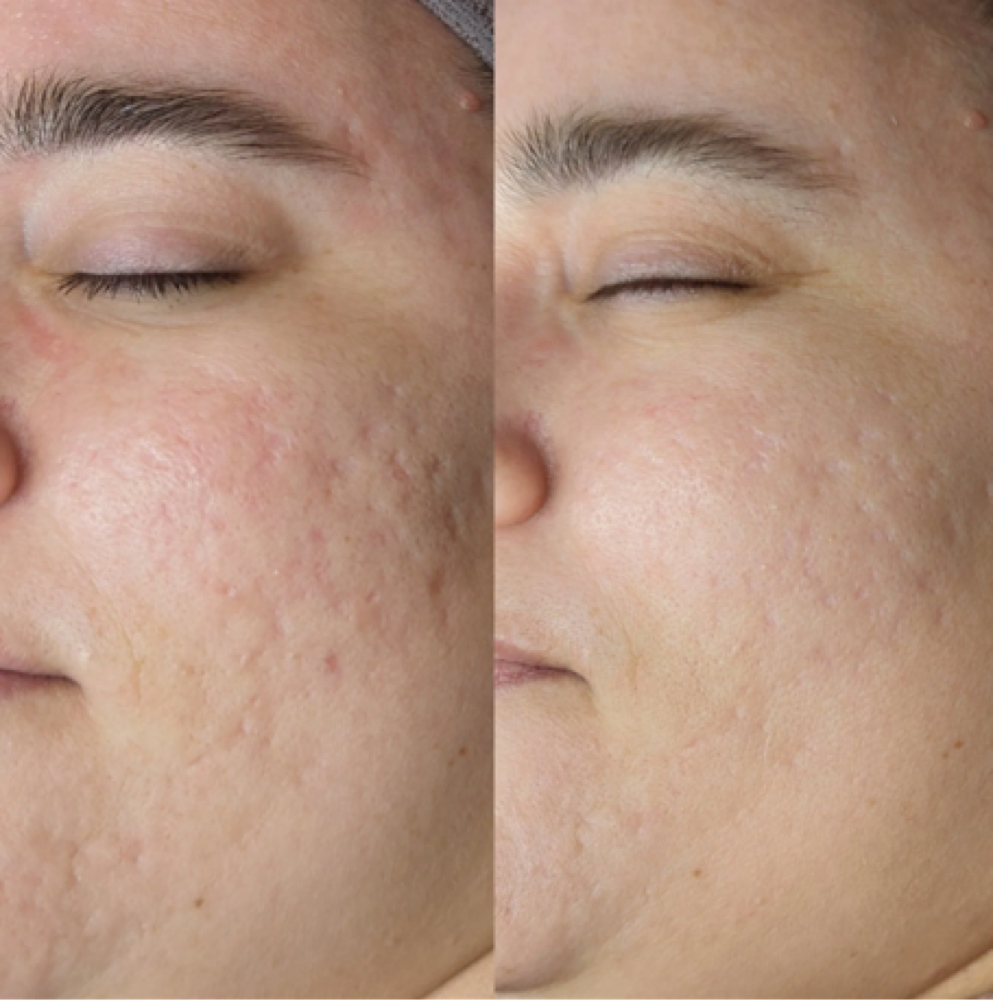 Microchanneling Package (3)