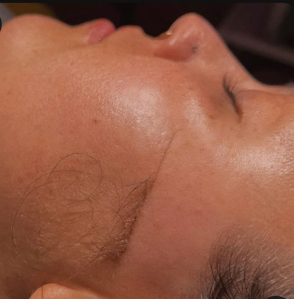 Dermaplane