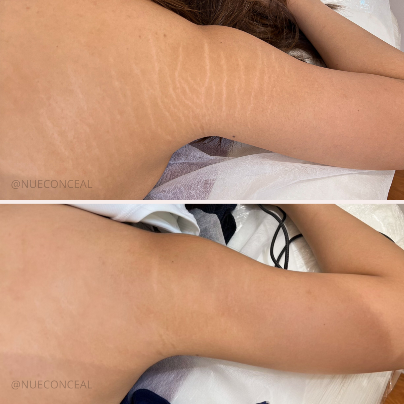 Stretch Mark Camouflage at Moonlit Beauty and Ink in Lewisville, TX