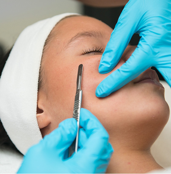 DERMAPLANING