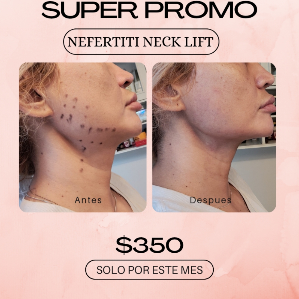 NEFERTITI'S NECK LIFT at Boujee Asthetics ✨ in Tucson, AZ