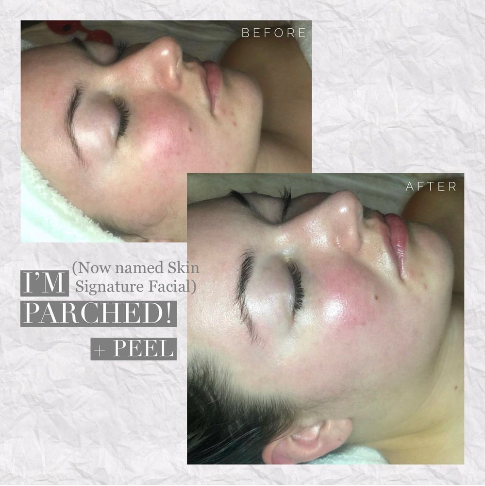 Single Chemical Peel