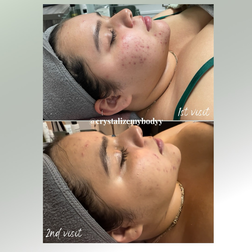 Teen Facial