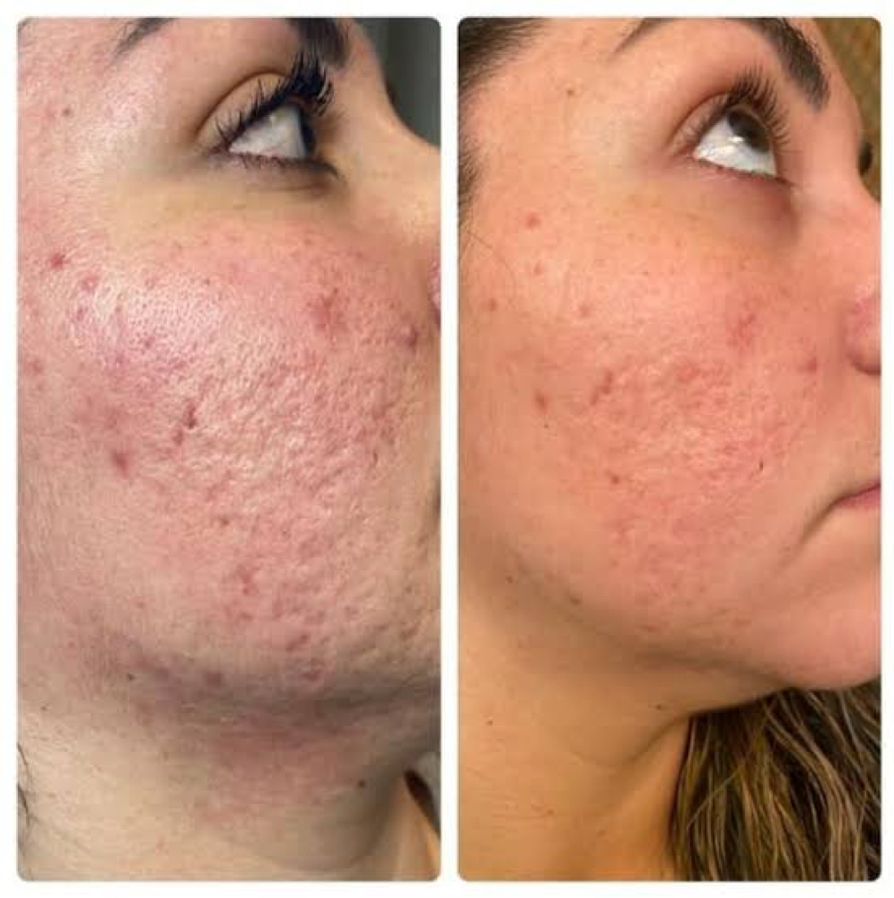 Acne Scar-Texture Repair Treatment at Luminous Glow Skin & Laser in Buckeye, AZ