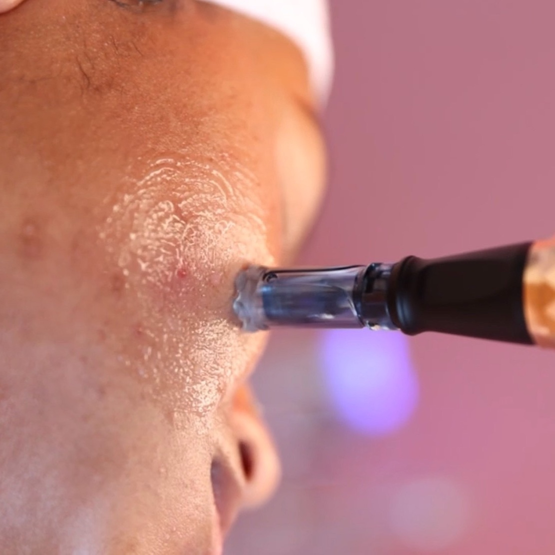 Microneedling at Classy & Confident Esthetics in Atlanta, GA