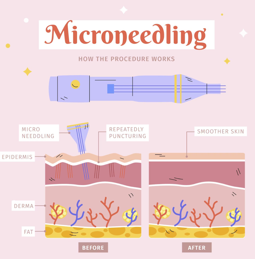 Microneedle 3 Series