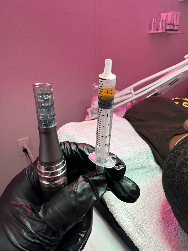 Microneedling + PRP Liquid Gold