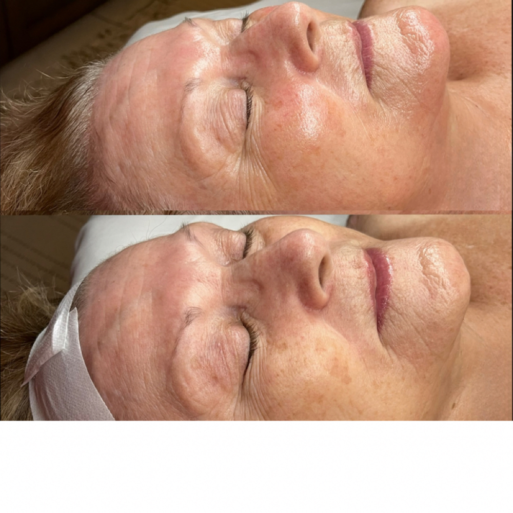 Glowing Esthetics Signature Facial at Glowing Esthetics in Pooler, GA