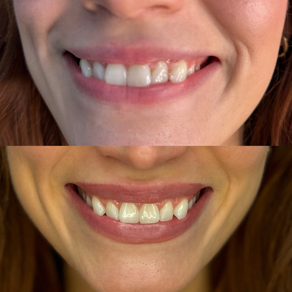 Lip Flip at Palméra Aesthetics in Killeen, TX